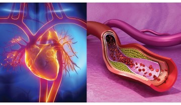 Arterial Plaque Rupture