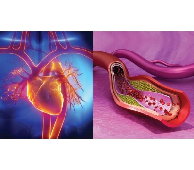 Arterial Plaque Rupture